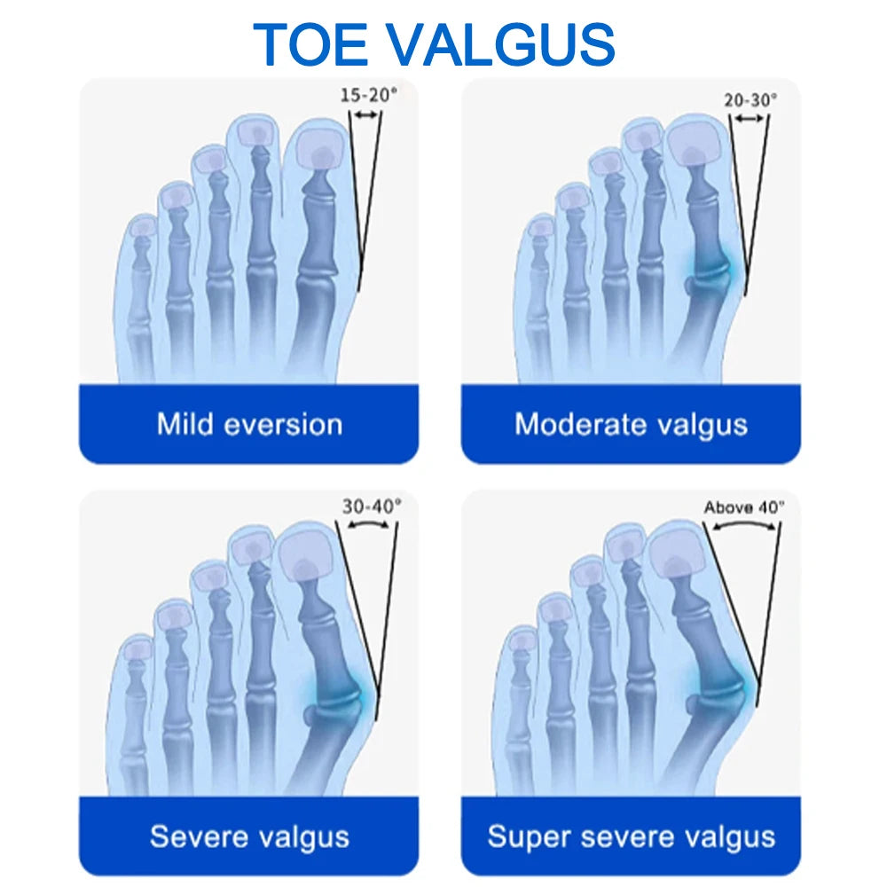 Bunion corrector